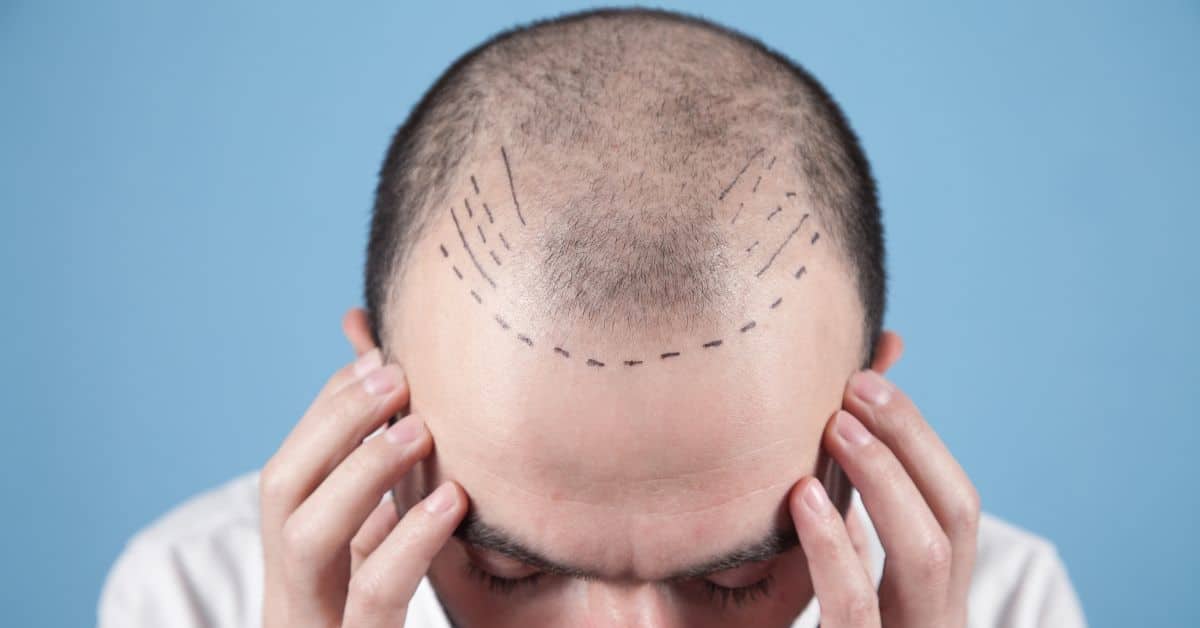 אתה שוקל לעשות השתלת שיער אלו 6 טיפים חשובים
